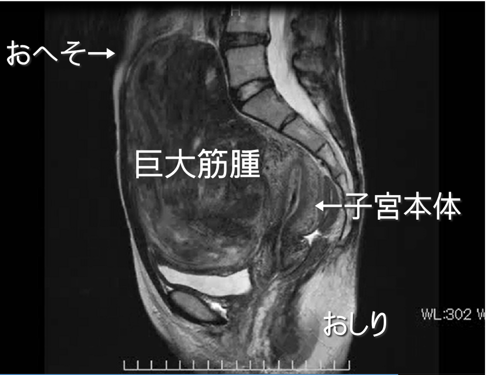 筋 トレ で 子宮 筋腫 が なくなる